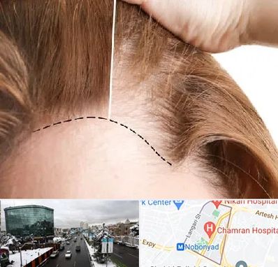 کاشت مو برای خانمها در اقدسیه 