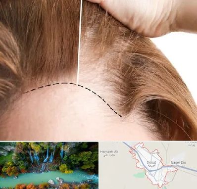 کاشت مو برای خانمها در دورود