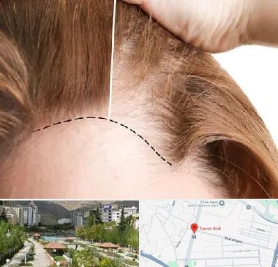 کاشت مو برای خانمها در بلوار تعاون