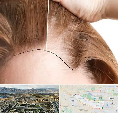 کاشت مو برای خانمها در منطقه 21 تهران 