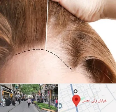 کاشت مو برای خانمها در ولیعصر شهریار