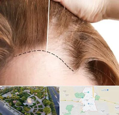 کاشت مو برای خانمها در کاشمر