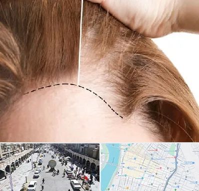 کاشت مو برای خانمها در نادری اهواز