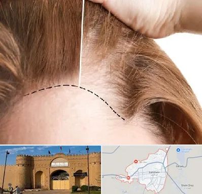 کاشت مو برای خانمها در ایرانشهر