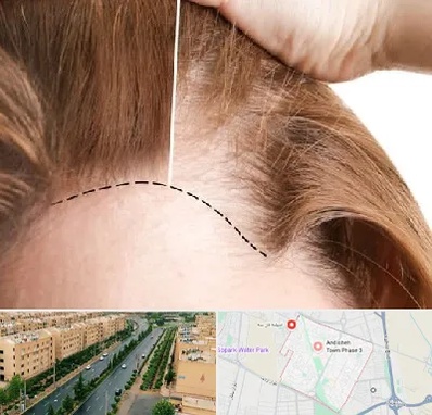 کاشت مو برای خانمها در فاز سه اندیشه