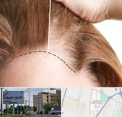 کاشت مو برای خانمها در فاز یک اندیشه