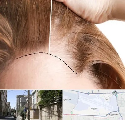 کاشت مو برای خانمها در مهرآباد