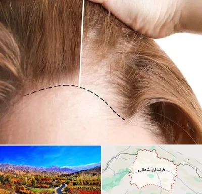 کاشت مو برای خانمها در خراسان شمالی