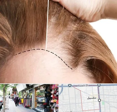 کاشت مو برای خانمها در سلسبیل