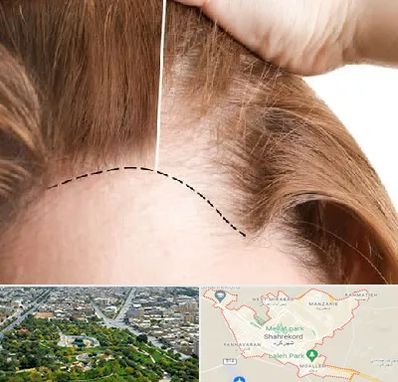 کاشت مو برای خانمها در شهرکرد