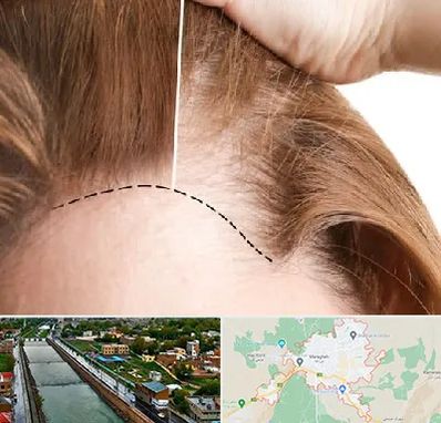 کاشت مو برای خانمها در مراغه