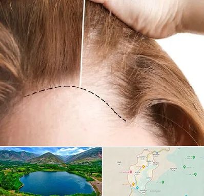 کاشت مو برای خانمها در رودبار