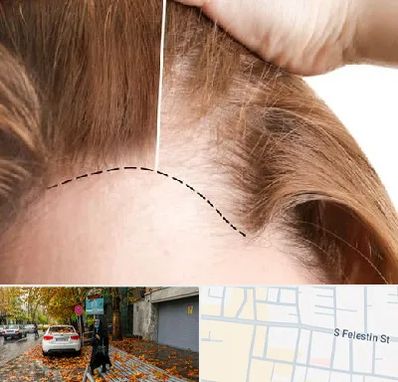 کاشت مو برای خانمها در خیابان فلسطین