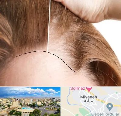 کاشت مو برای خانمها در میانه