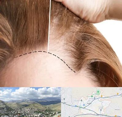 کاشت مو برای خانمها در رودهن