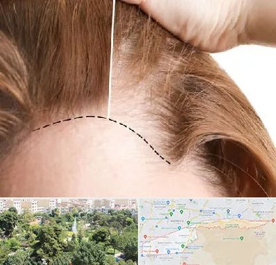 کاشت مو برای خانمها در منطقه 13 تهران 