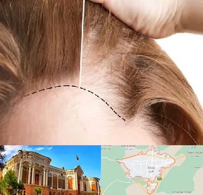 کاشت مو برای خانمها در خوی