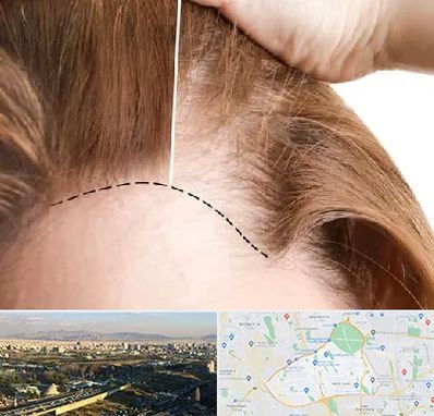 کاشت مو برای خانمها در منطقه 19 تهران 