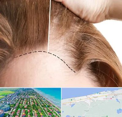 کاشت مو برای خانمها در فریدونکنار