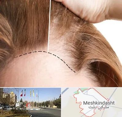 کاشت مو برای خانمها در مشکین دشت