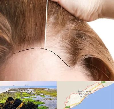 کاشت مو برای خانمها در بندرلنگه