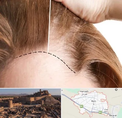 کاشت مو برای خانمها در بم