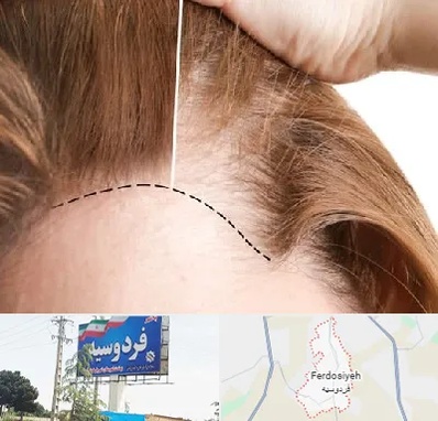 کاشت مو برای خانمها در فردوسیه شهریار