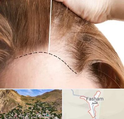 کاشت مو برای خانمها در فشم