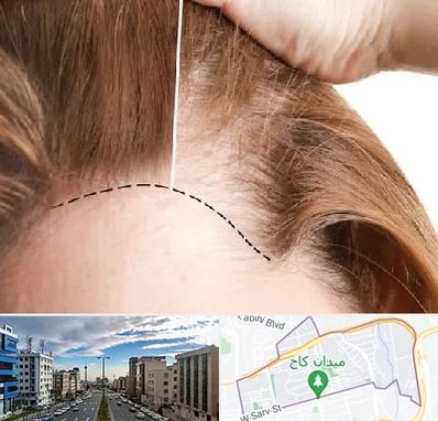 کاشت مو برای خانمها در سعادت آباد 