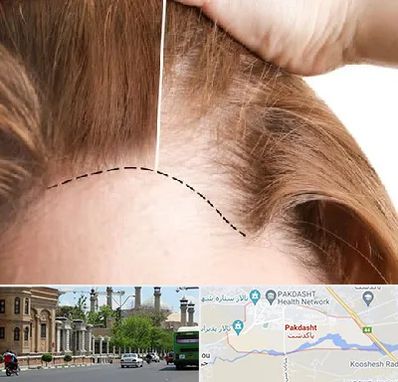 کاشت مو برای خانمها در پاکدشت