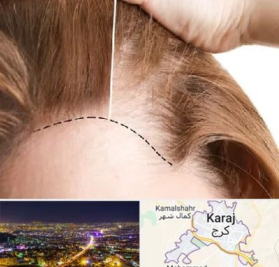 کاشت مو برای خانمها در کرج