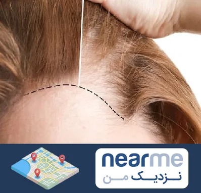 کاشت مو برای خانمها در نزدیک من