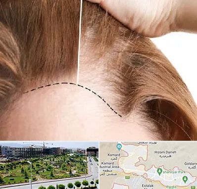 کاشت مو برای خانمها در پردیس