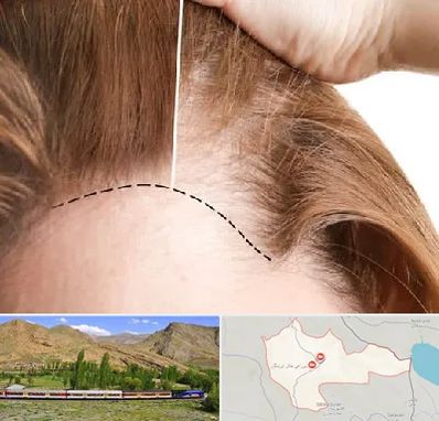 کاشت مو برای خانمها در خاش