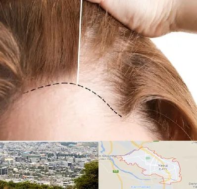 کاشت مو برای خانمها در یاسوج