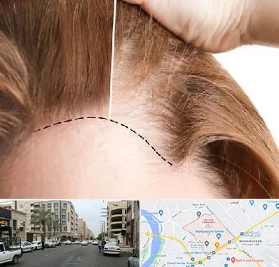 کاشت مو برای خانمها در زیتون کارمندی اهواز