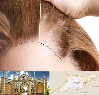 کاشت مو برای خانمها در سمنان