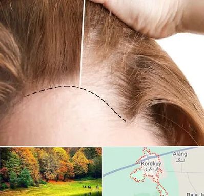 کاشت مو برای خانمها در کردکوی
