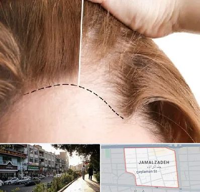 کاشت مو برای خانمها در خیابان جمالزاده