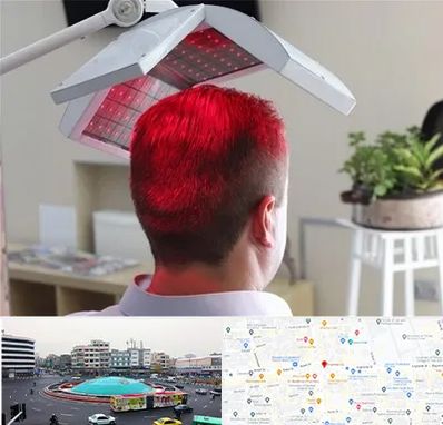 کاشت مو با لیزر در میدان انقلاب 