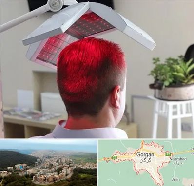 کاشت مو با لیزر در گرگان