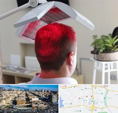 کاشت مو با لیزر در شهرک راه آهن