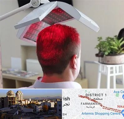 کاشت مو با لیزر در فرمانیه 