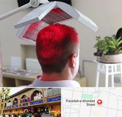 کاشت مو با لیزر در 15 خرداد