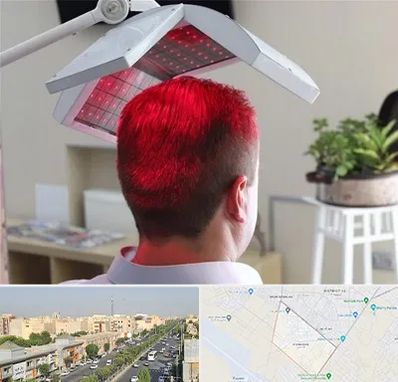 کاشت مو با لیزر در کیانمهر کرج