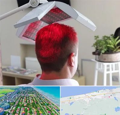 کاشت مو با لیزر در فریدونکنار