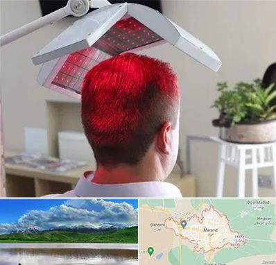 کاشت مو با لیزر در مرند