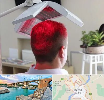 کاشت مو با لیزر در دزفول