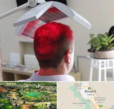 کاشت مو با لیزر در بروجرد