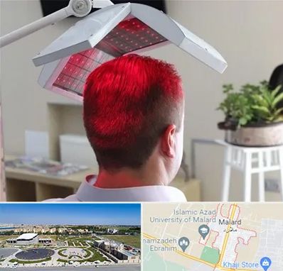 کاشت مو با لیزر در ملارد